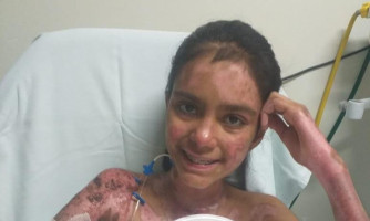 Menina que teve 84% do corpo queimado em Pontes e Lacerda se recupera em Cuiabá